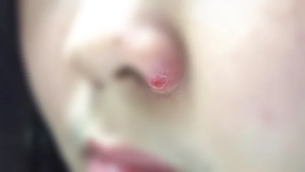 hiruscar-anti-acne-1