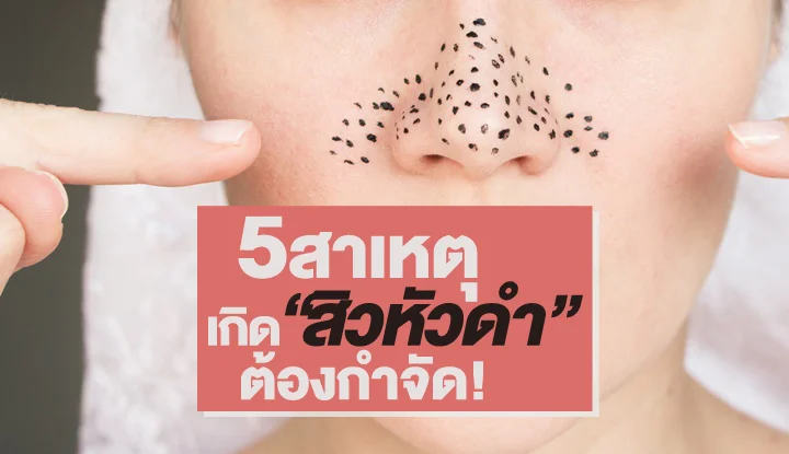 5-causes-blackheads-to-get-rid-of