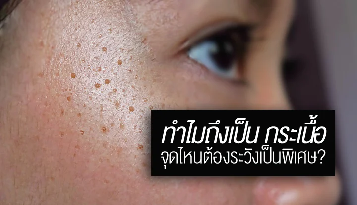 seborrheic-keratosis