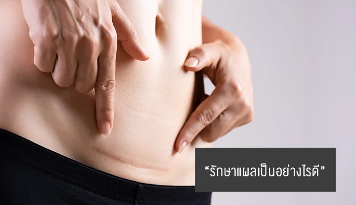 แผลเป็น